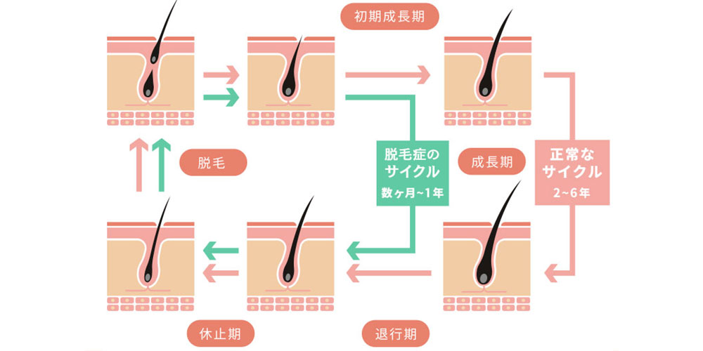 ヘアサイクルの乱れ